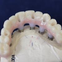 Full Arch in Zirconia