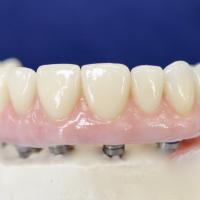 Full Arch in Zirconia