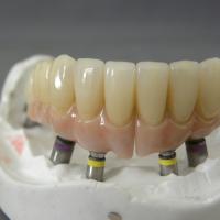 Series of full mouth restoration on Straumann implants