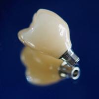 Screw Retained Zirconia Implant Crown