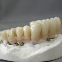Restoration with Straumann Implants